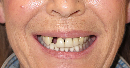 Above   Beyond Dentistry   Implants | Sports Mouthguards, Night Guards and CEREC