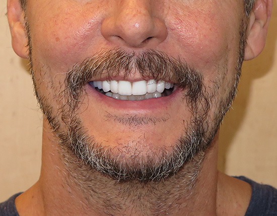 Above   Beyond Dentistry   Implants | TMJ Disorders, Air Abrasion and Ceramic Crowns