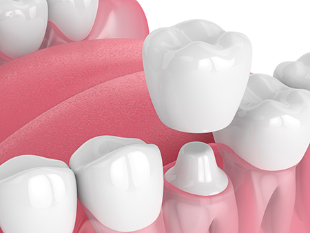 Above Beyond Dentistry Implants